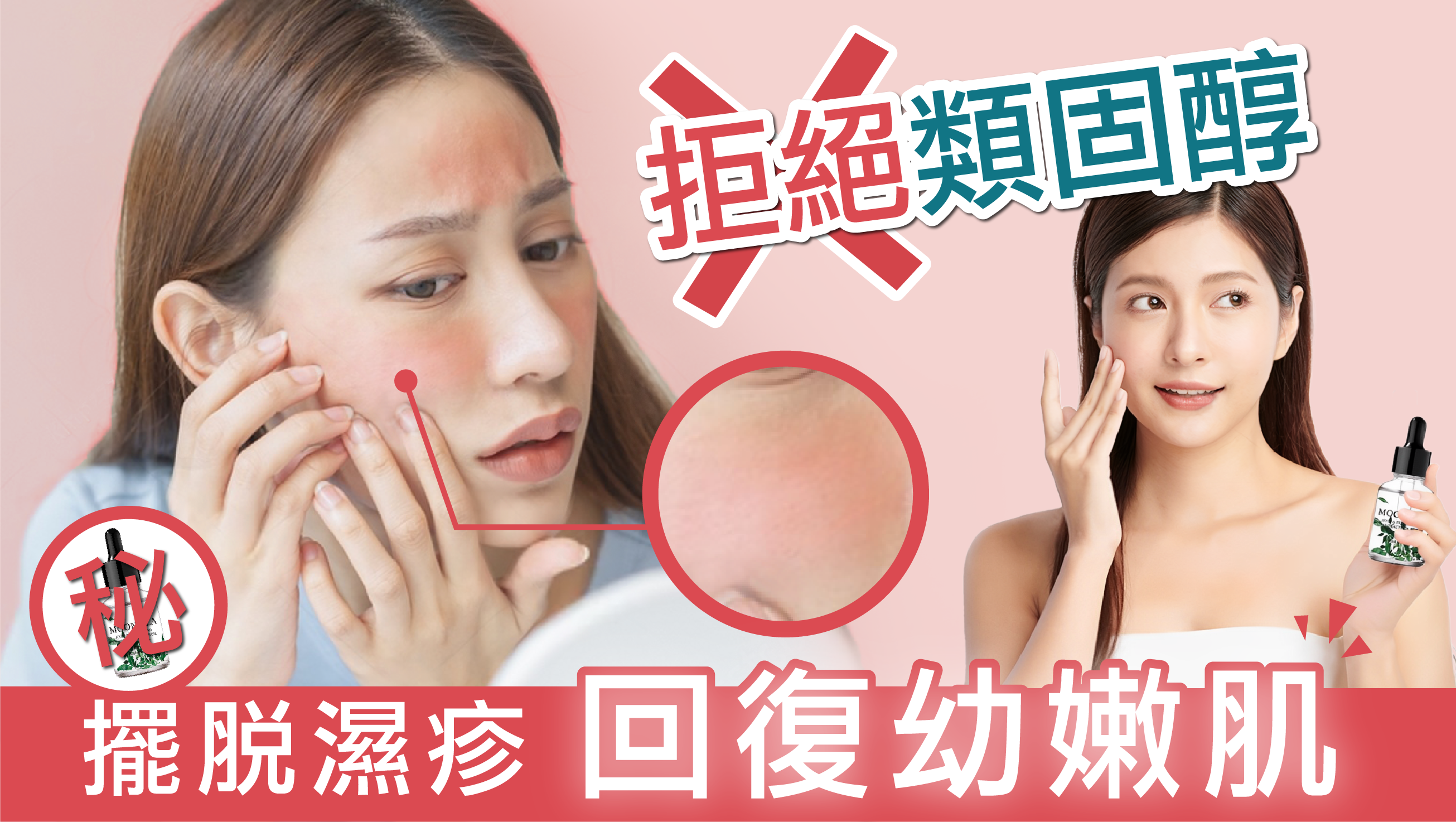 拒絕類固醇!擺脫濕疹 回復幼嫩肌!