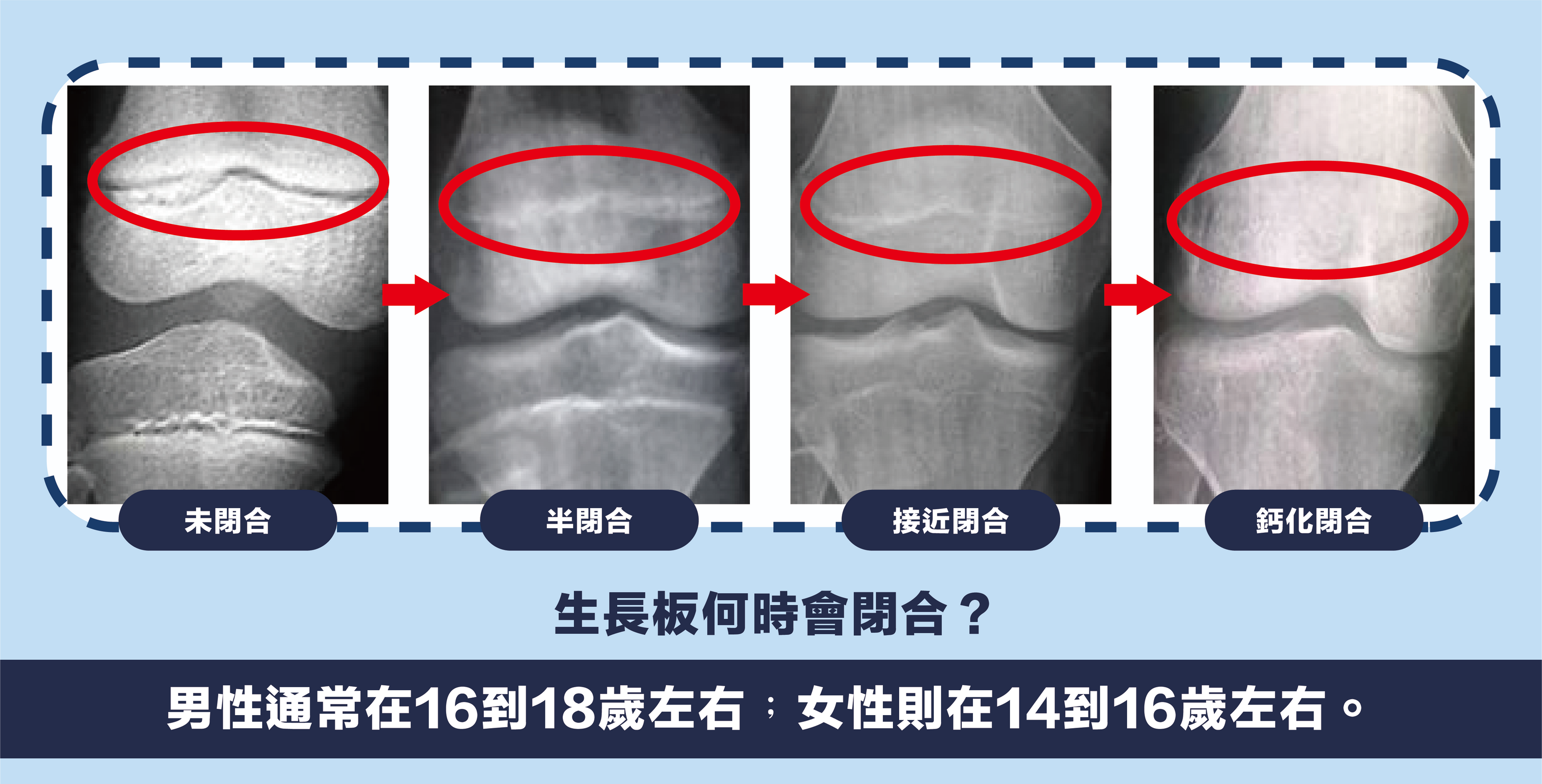 生長板何時會閉合?