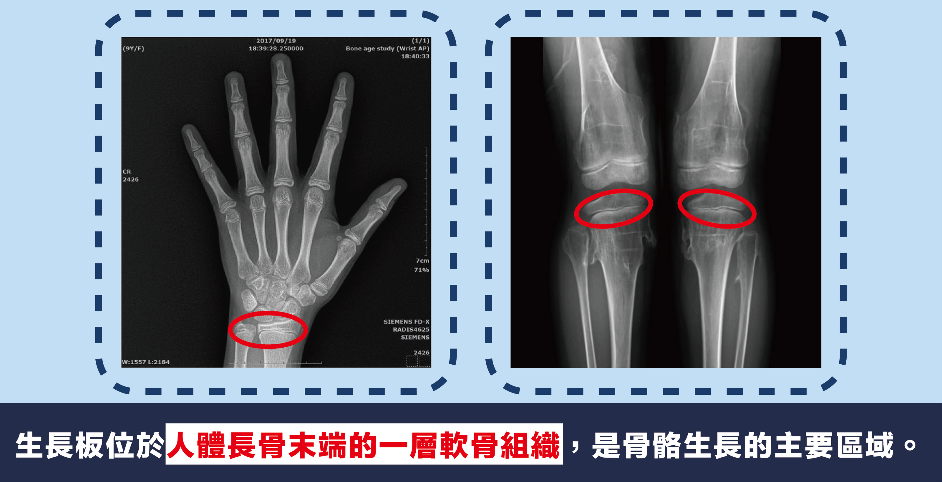 生長板與身高的關係
