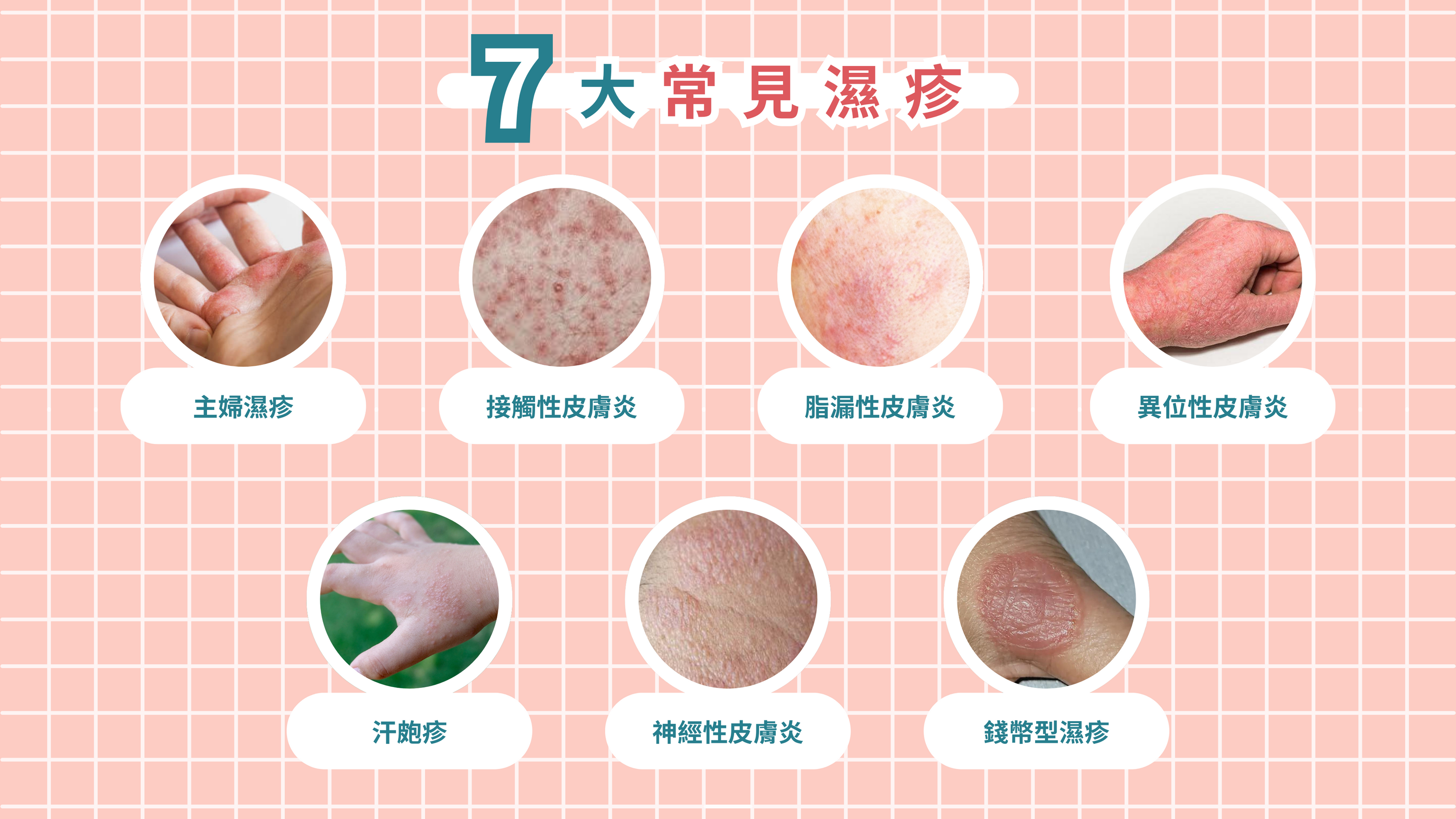 7大常見濕疹