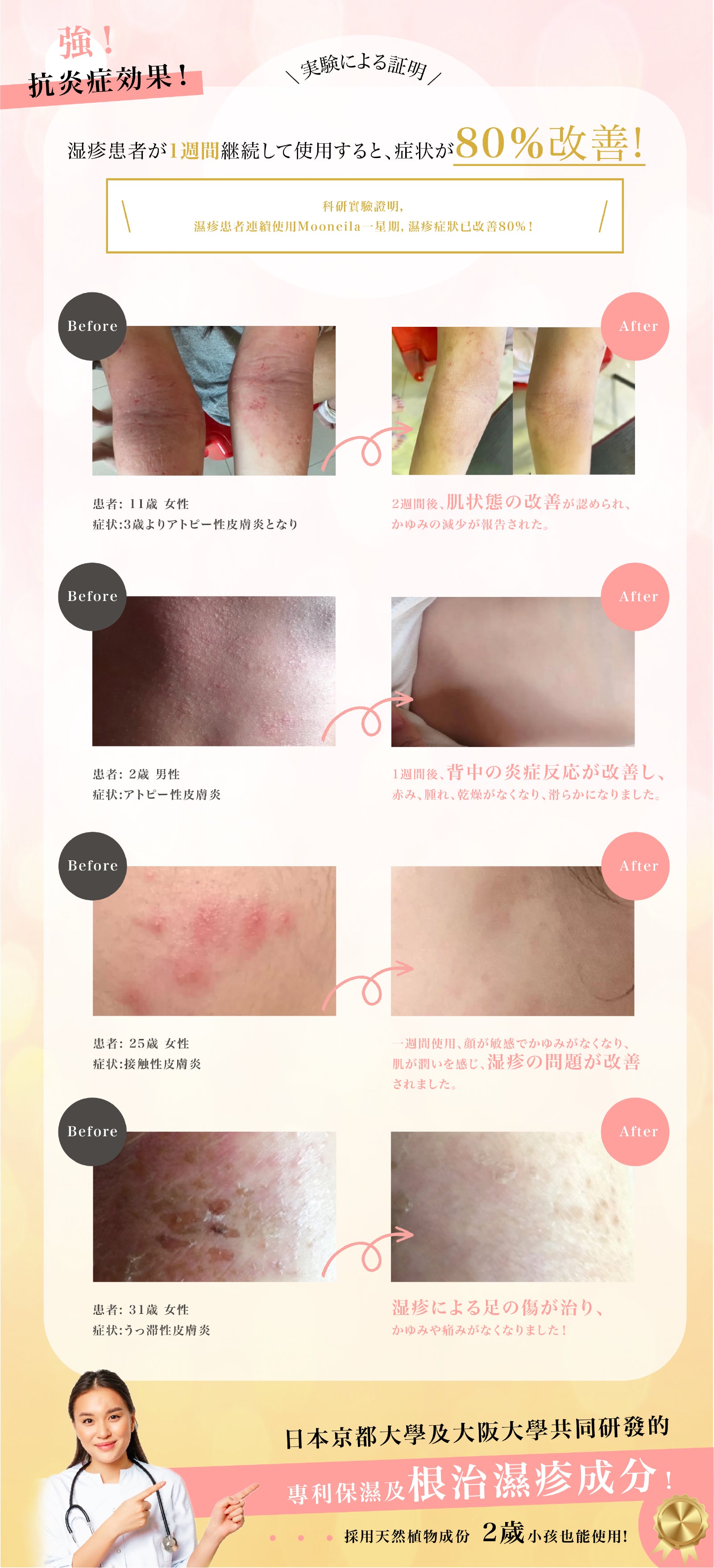 濕疹患者痊癒達80%