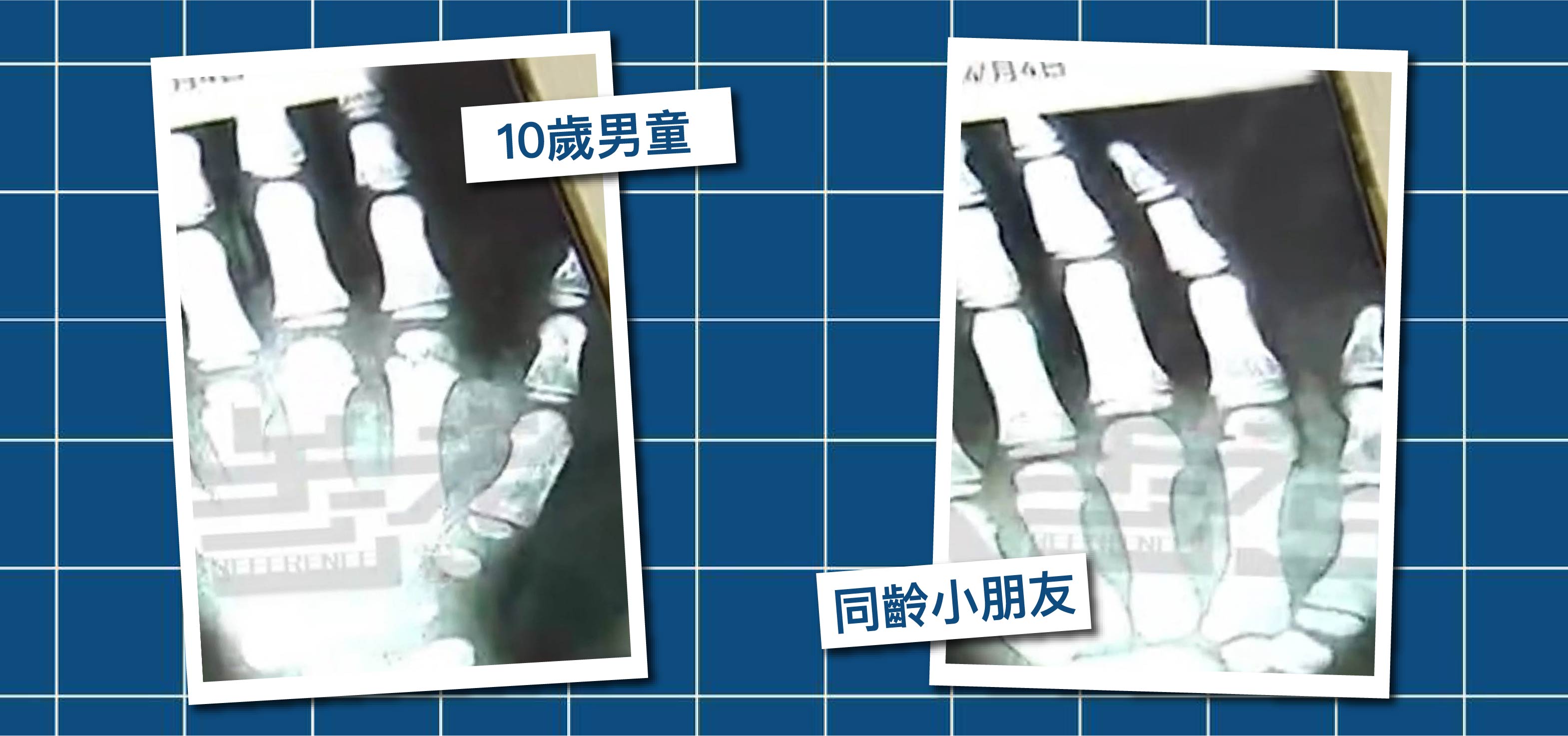 發育比人慢4年 10歲僅高110cm