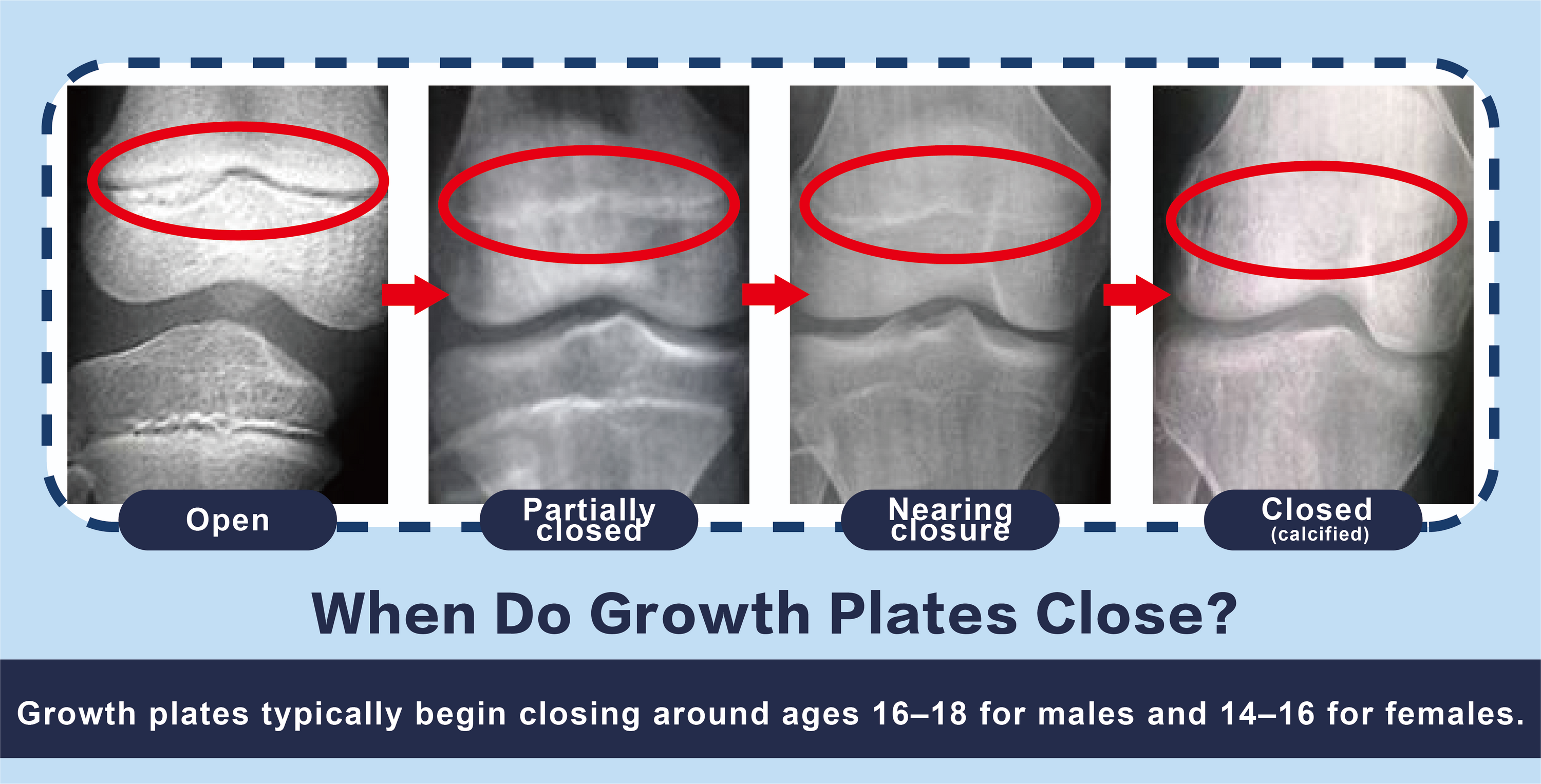 A Deep Dive Into Growth Plates And Height Tenchi Health Tips a-deep-dive-into-growth-plates-and-height-tenchi-health-tips